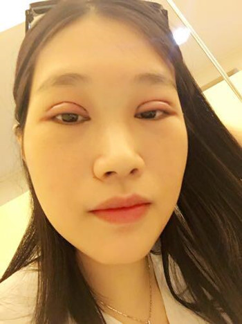 做全切双眼皮,花了8000多,第三天的反馈