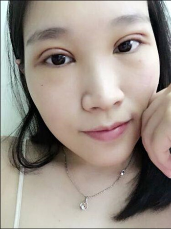 做全切双眼皮,花了8000多,第三天的反馈