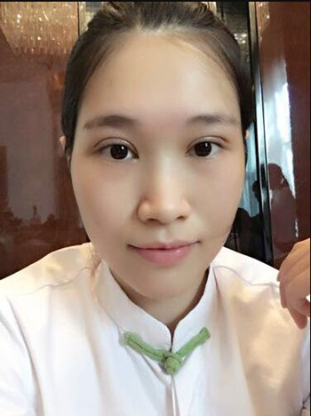 做全切双眼皮,花了8000多,第三天的反馈