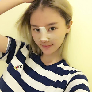 长沙硅胶隆鼻+鼻头缩小，两个月*果分享