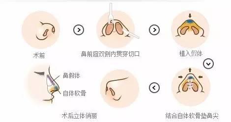 *手术需要局麻还是全麻?怎么选?