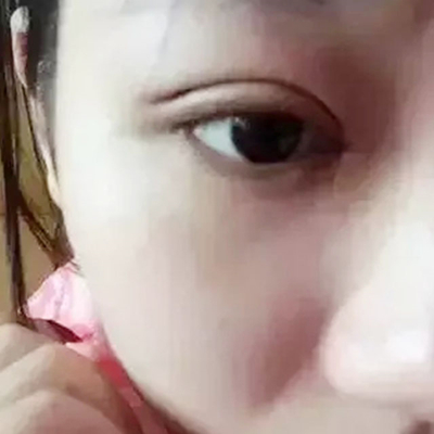 成都大华韩艺做双眼皮怎么样？全切双眼皮案例