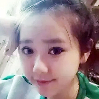 成都大华韩艺做双眼皮怎么样？全切双眼皮案例