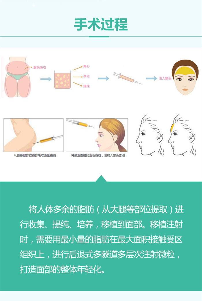 面部填充,选自体脂肪好还是玻尿酸好?