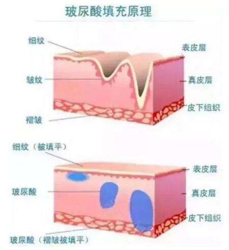 面部填充,选自体脂肪好还是玻尿酸好?