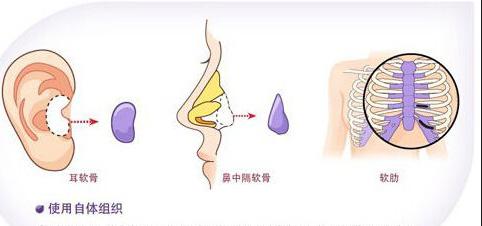 自体隆鼻能保持多久?—尽美网