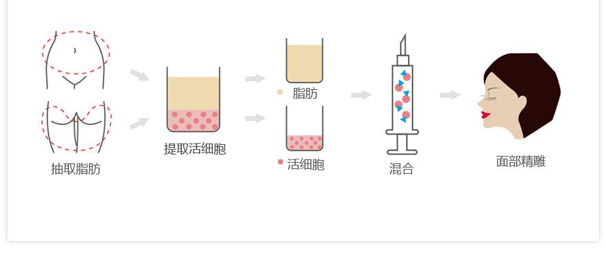 自体隆鼻能保持多久?—尽美网