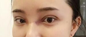 割双眼皮+开内眼角整形两个多月，恢复超快