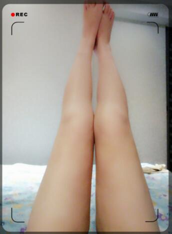 西安瑞丽水动力吸脂瘦大腿*果，案例参考