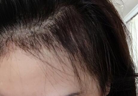 南京明基发际线种植5个月*果图，案例分享