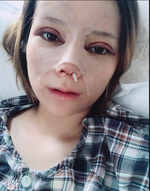 肋软骨隆鼻拆线当天的*果，实时分享