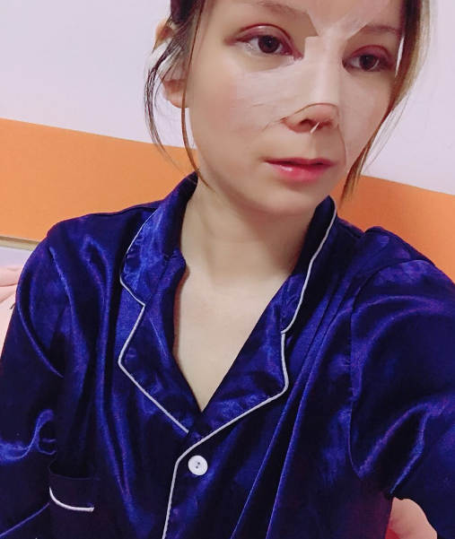 肋软骨隆鼻拆线当天的*果，实时分享