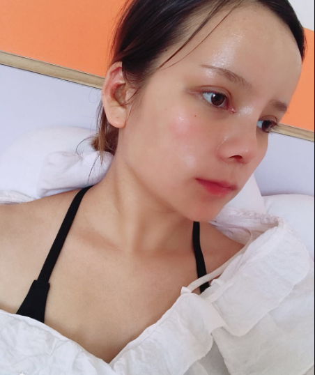 肋软骨隆鼻拆线当天的*果，实时分享