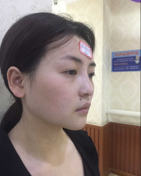 *加**果分享,恢复三个多月了
