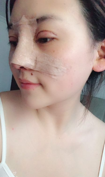 *加**果分享,恢复三个多月了