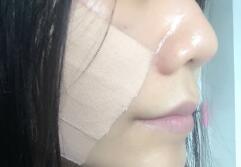 面部埋线提升案例，手术价格2880元