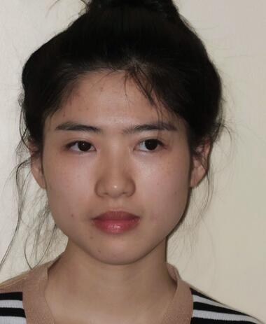 尽美网下颌角截骨案例，恢复过程、*果对比