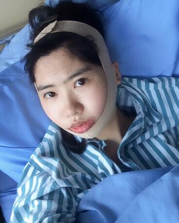 尽美网下颌角截骨案例，恢复过程、*果对比