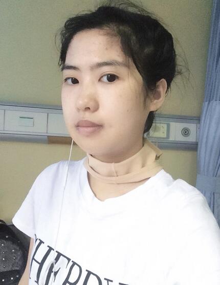 尽美网下颌角截骨案例，恢复过程、*果对比