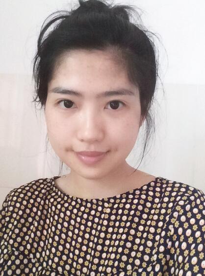 尽美网下颌角截骨案例，恢复过程、*果对比