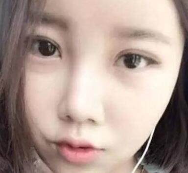 厦门整形医院做双眼皮哪家好？