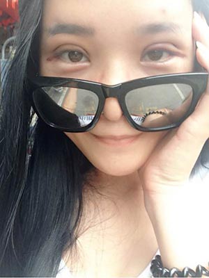 双眼皮恢复了，割的7.5mm宽。尽美网双眼皮案例