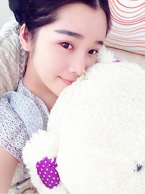 双眼皮恢复了，割的7.5mm宽。尽美网双眼皮案例