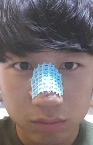 尽美网男士歪鼻矫正反馈案例