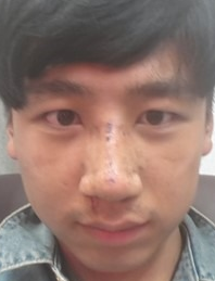 尽美网男士歪鼻矫正反馈案例