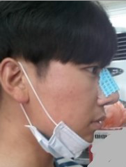 尽美网男士歪鼻矫正反馈案例