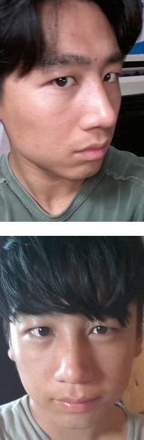尽美网男士歪鼻矫正反馈案例