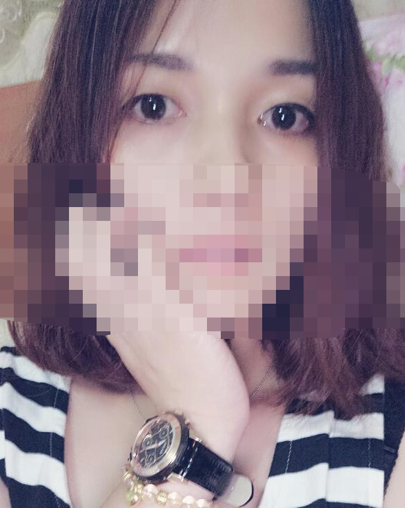 88天的蜕变，单眼皮变双眼皮