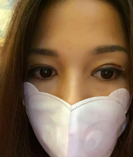 88天的蜕变，单眼皮变双眼皮