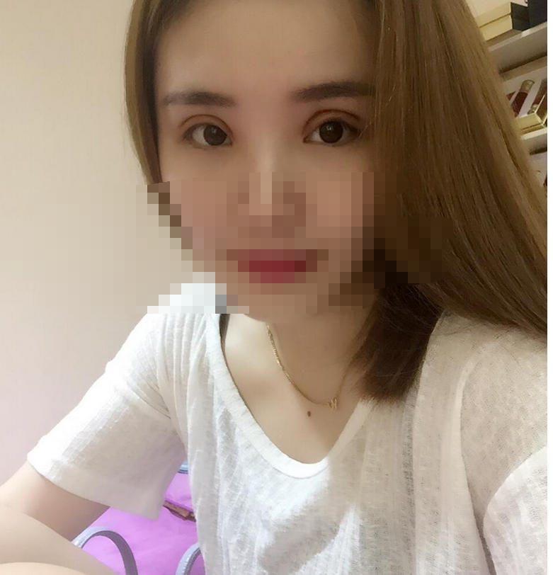 欧式双眼皮拆线当天的情况了，晒照~