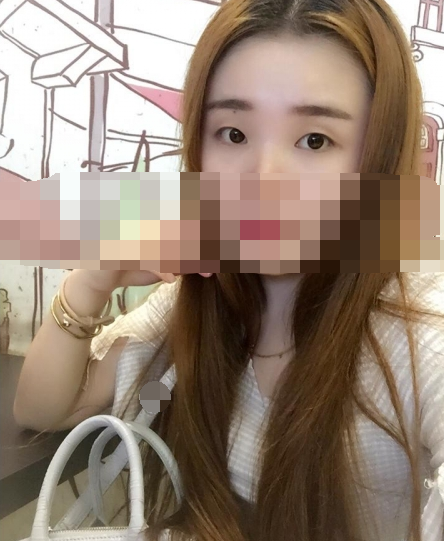 欧式双眼皮拆线当天的情况了，晒照~
