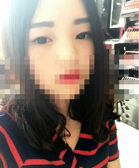 现在是做双眼皮后的第78天，老公天天叫我双眼皮