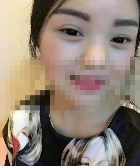 现在是做双眼皮后的第78天，老公天天叫我双眼皮