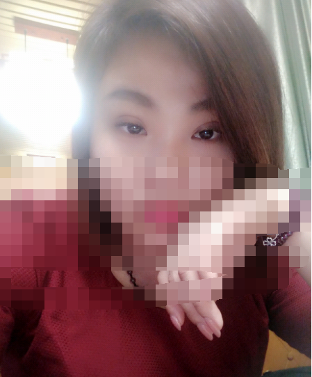 做了纳米*双眼皮，今天15天了，肿啊