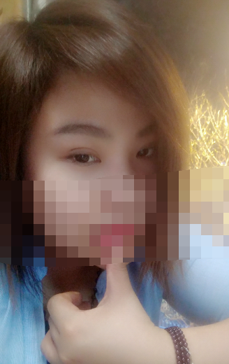 做了纳米*双眼皮，今天15天了，肿啊