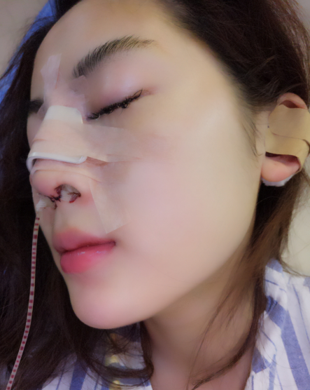 膨体加耳软骨隆鼻术后15天，鼻子好大好肿