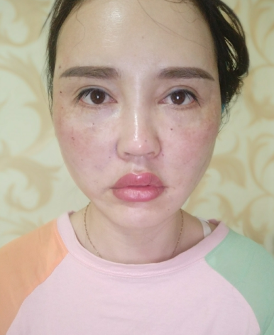 面部*提升70多天了，来这里反馈一下*果
