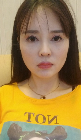 面部*提升70多天了，来这里反馈一下*果