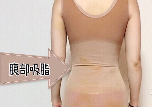 肚子很大,脂肪很多吸脂的*果好吗?
