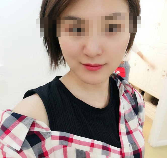 下颌角整形术后怎么护理,面部骨骼整形通用