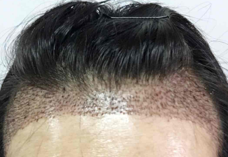 植发际线拯救我的大脑门，7个多月了*果很好