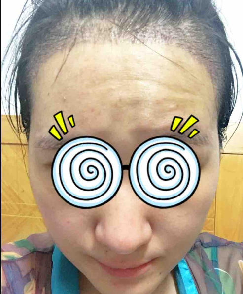 植发际线拯救我的大脑门，7个多月了*果很好