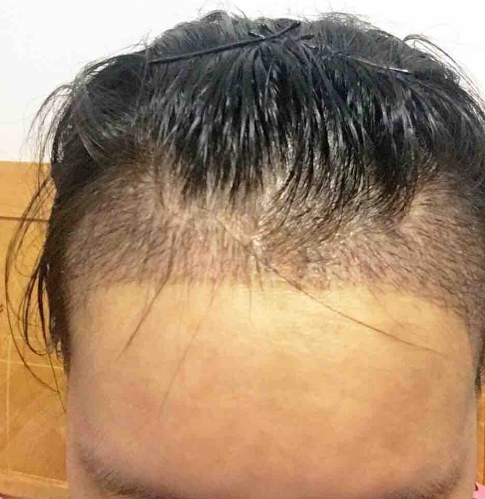 植发际线拯救我的大脑门，7个多月了*果很好