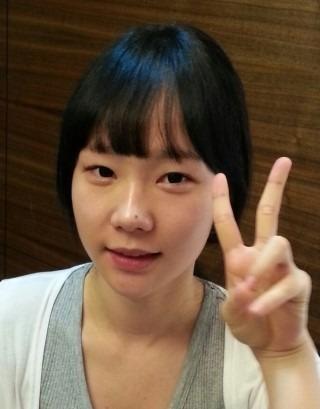全切双眼皮+开内眼角+开外眼角记录，分享一波