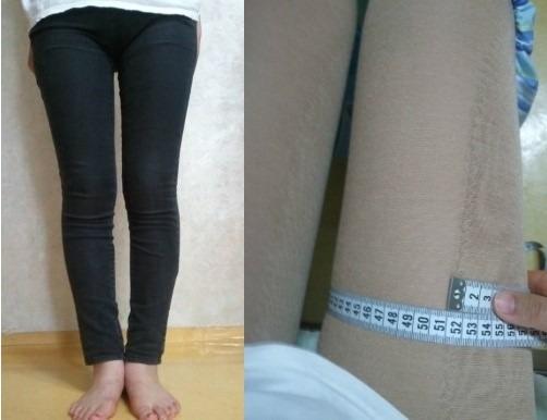 吸脂瘦大腿手术后4周变化，超高兴