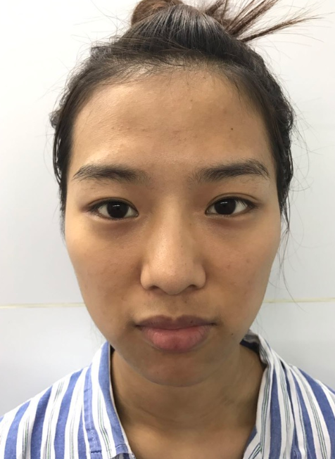 自体脂肪丰面颊一次填充多少脂肪合适?